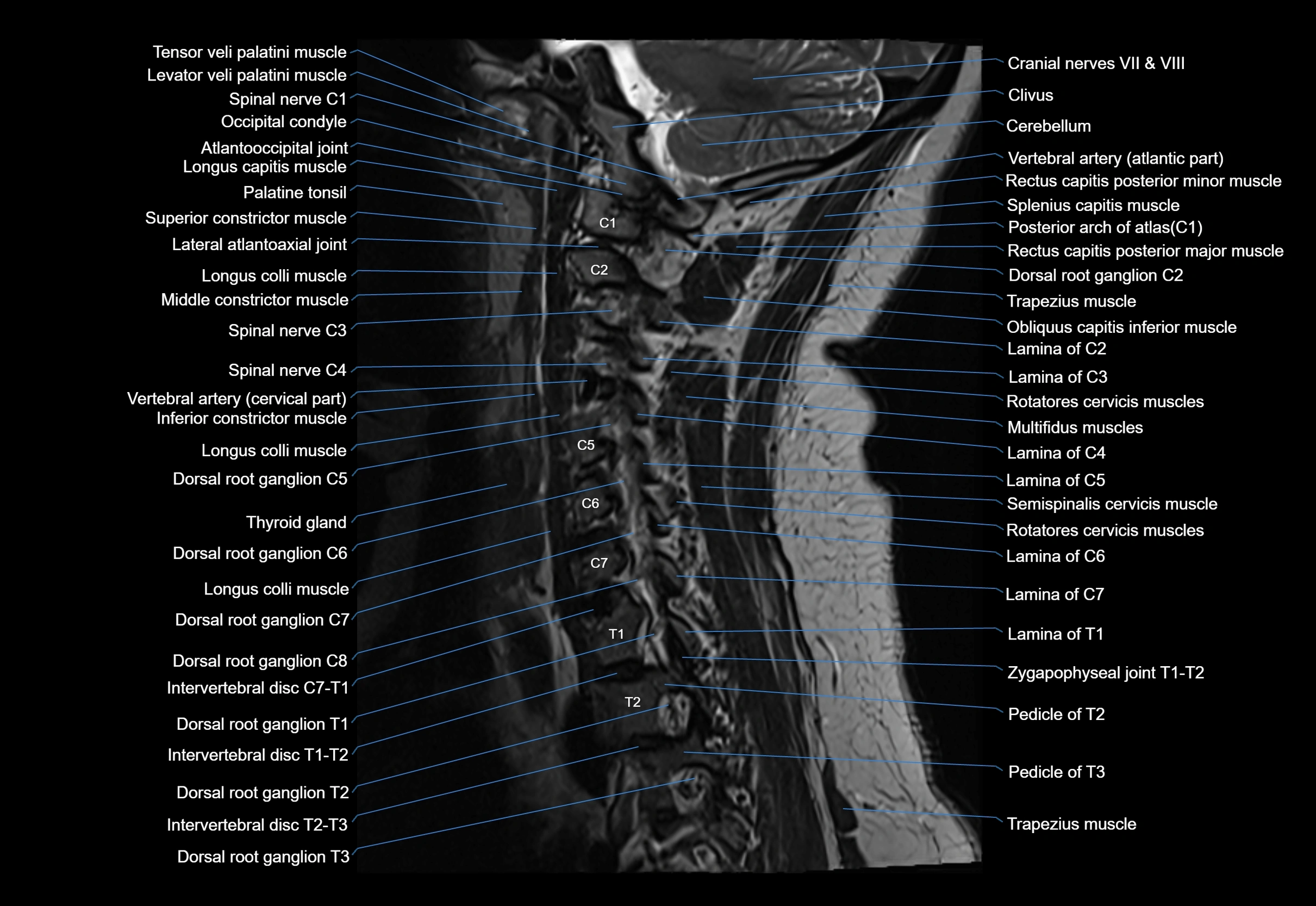 cervical spine cross sectional MRI anatomy 3T MRI  sagittal image-img-00001-00011.webp